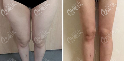 广州曙光大腿吸脂案例