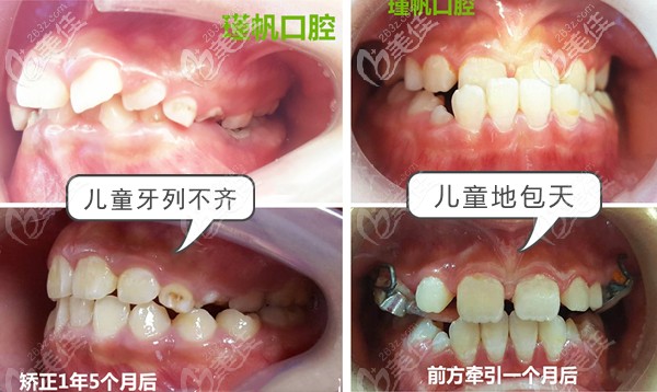 周瑾帆医生的儿牙矫正案例