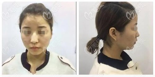 鼻综合手术前 鼻综合手术前