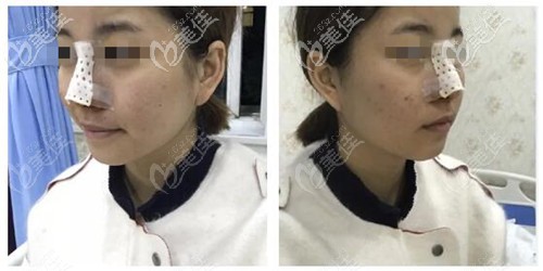 鼻综合术后效果 鼻综合术后效果