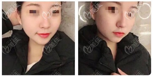 鼻翼缩小外切12天 鼻翼缩小外切12天