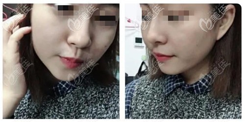 鼻综合恢复3个月效果 鼻综合恢复3个月效果