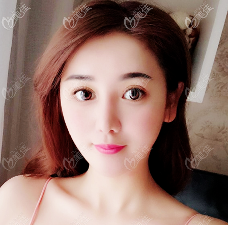 佛山美莱王燕做的双眼皮也太好看了吧