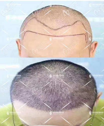 菏泽华美发际线种植15天效果图