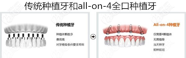 老年人做全口种植牙要几十万吗