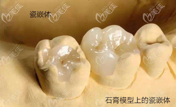 瓷嵌体示意图
