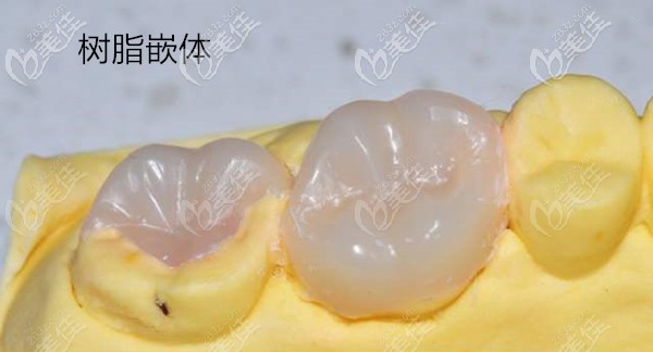 树脂嵌体模型图