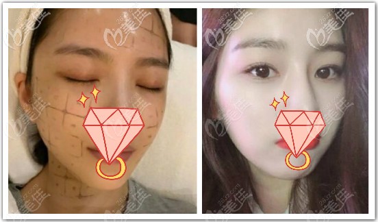 热玛吉全脸一年效果图片 热玛吉全脸一年效果图片