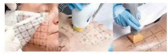 真热玛吉打法介绍 真热玛吉打法介绍