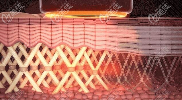 热玛吉作用原理介绍 热玛吉作用原理介绍