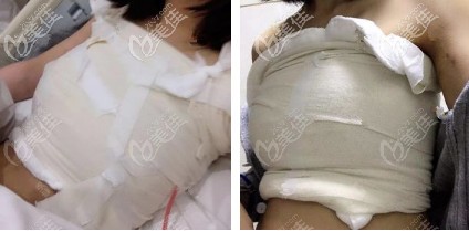 刚做完隆胸手术胸部肿胀 刚做完隆胸手术胸部肿胀