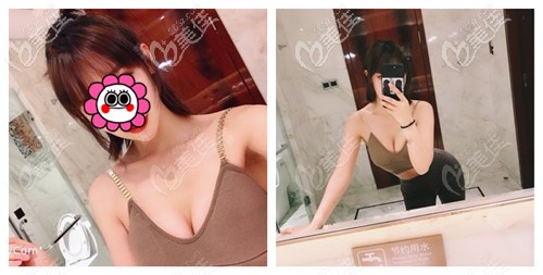 听网友说进口曼托假体275过大 就选择做水滴型225cc假体隆胸术后效果超自然