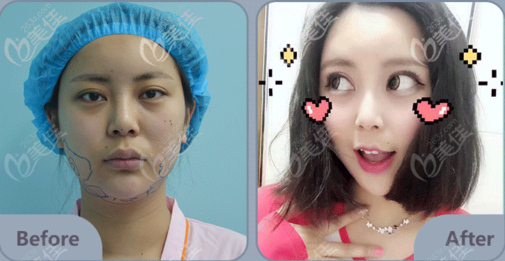 我在北京艺星做面部吸脂案例效果告诉你连凯峰吸脂好不好