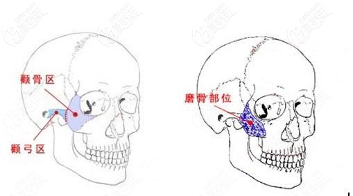 颧骨磨骨的位置 颧骨磨骨的位置