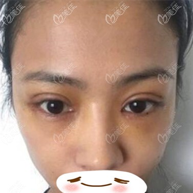 双眼皮修复术后5天效果照