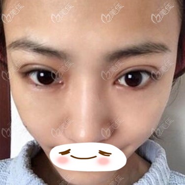 双眼皮修复术后10天照