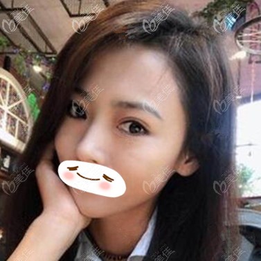 双眼皮修复术后20天恢复效果照