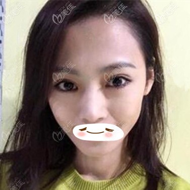 眼修复术后30天效果照