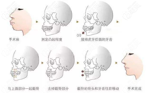 正颌手术的过程 正颌手术的过程