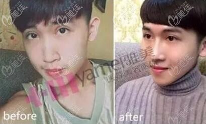 雅美田芳斌隆鼻真人前后对比案例图