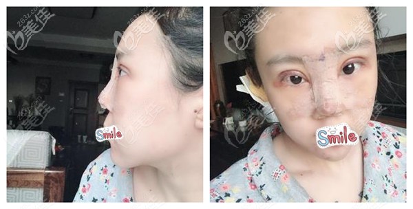 眼鼻综合术后第二天变红肿 眼鼻综合术后第二天变红肿