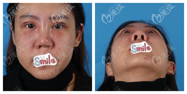 刚做完眼鼻综合术后肿胀感强烈 刚做完眼鼻综合术后肿胀感强烈