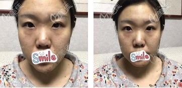 术前鼻子宽大塌平 术前鼻子宽大塌平