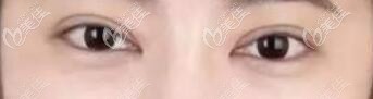 叶薇薇割双眼皮真人术后恢复照 叶薇薇割双眼皮真人术后恢复照