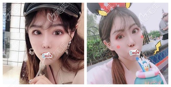 花3小时选择全麻方式做了眼鼻综合手术 恢复2个月我的五官已有较大改变