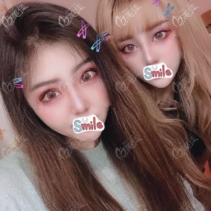 做眼鼻综合术后一个月鼻子消肿 做眼鼻综合术后一个月鼻子消肿