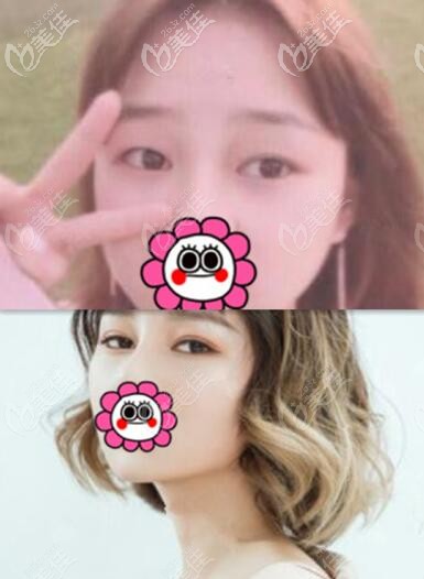 长沙协雅明经发双眼皮真人前后对比效果照 长沙协雅明经发双眼皮真人前后对比效果照