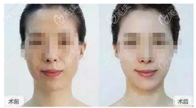 脸型长做脂肪填充后的效果对比