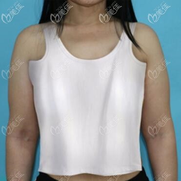 做假体隆胸术前照 做假体隆胸术前照