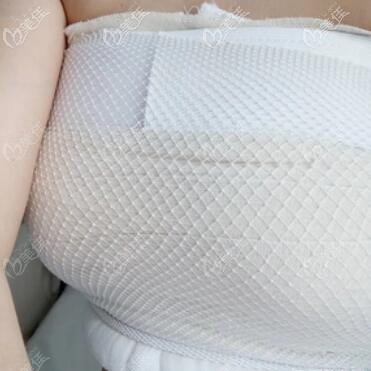 假体隆胸术后第3天照 假体隆胸术后第3天照