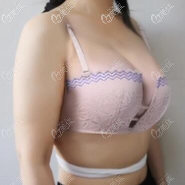 假体隆胸术后1周恢复效果照 假体隆胸术后1周恢复效果照