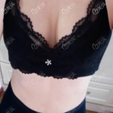 假体隆胸术后半个月恢复效果照片 假体隆胸术后半个月恢复效果照片