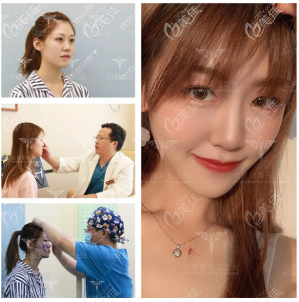 北京玉之光张红芳面部填充<span style=