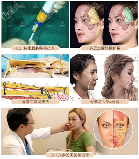 北京玉之光张红芳脂肪填充技术 北京玉之光张红芳脂肪填充技术