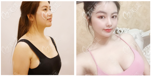 北京玉之光王明利自体脂肪丰胸<span style=