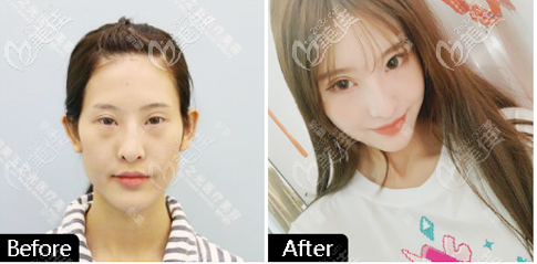 北京玉之光王明利面部脂肪填充<span style=