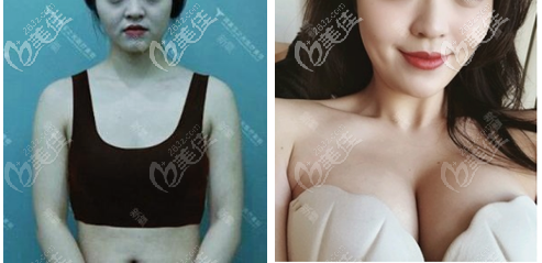 北京玉之光朱金成自体脂肪丰胸<span style=