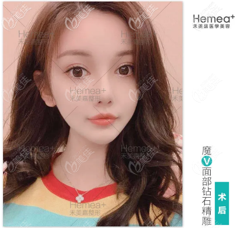 北京禾美嘉任学会自体脂肪面部填充<span style=