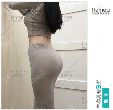 北京禾美嘉任学会自体脂肪丰臀<span style=