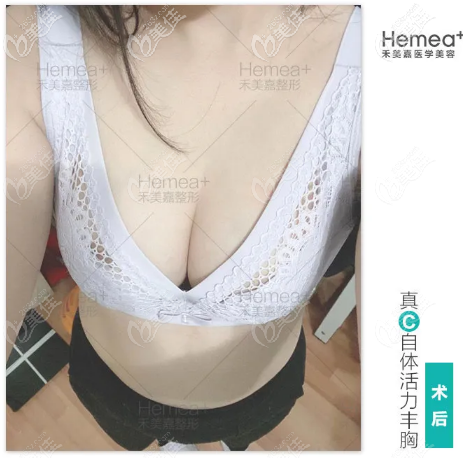 看北京禾美嘉任学会自体脂肪丰胸<span style=