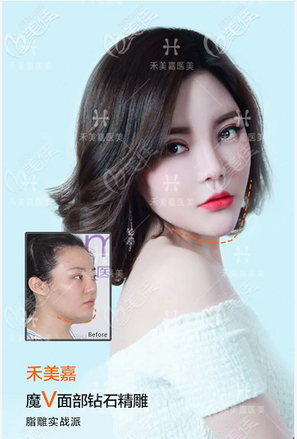 看北京禾美嘉任学会面部吸脂<span style= 看北京禾美嘉任学会面部吸脂<span style=