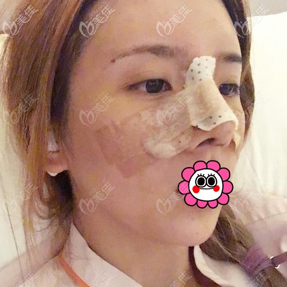 耳软骨隆鼻术后即刻