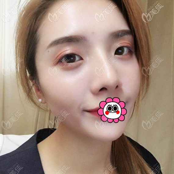 台州艺星耳软骨隆鼻效果怎么样