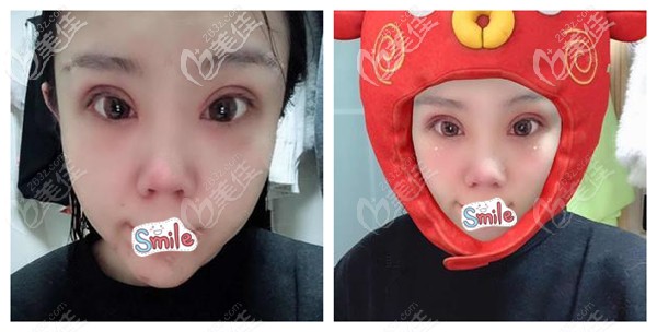 做眼鼻综合术后消肿一些 做眼鼻综合术后消肿一些