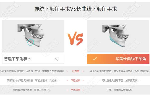 长曲线下颌角手术对比传统下颌角手术优势