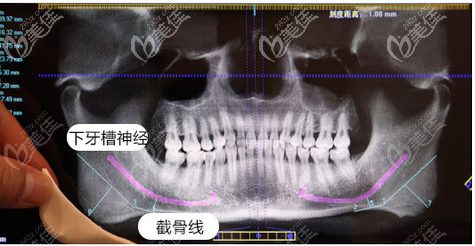 找高俊明做下颌角术前拍ct